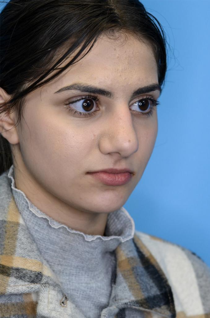 Patient KA's right oblique view one year after rhinoplasty
