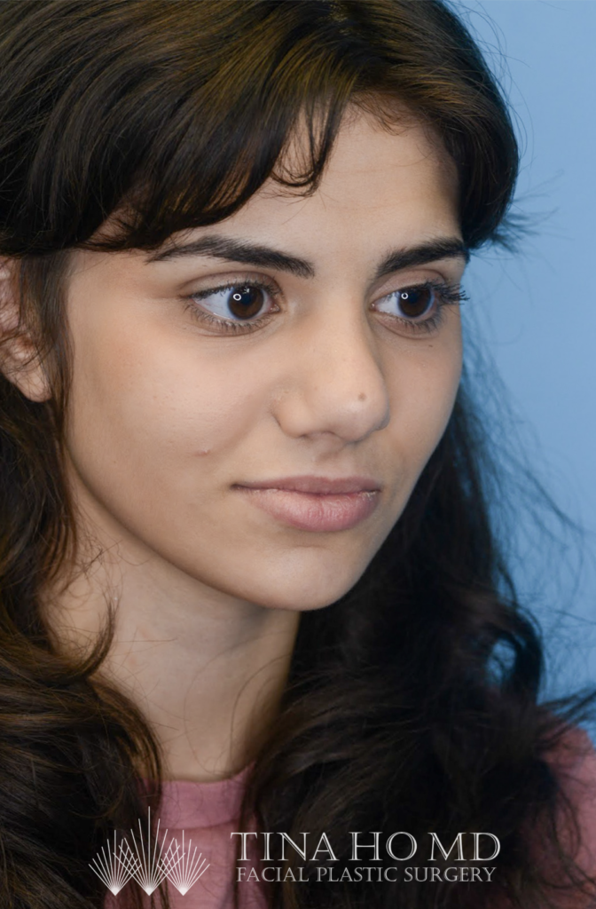 Patient KA's right oblique view one year after rhinoplasty, alternate view