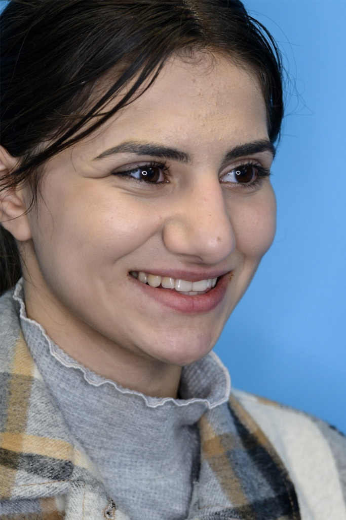 Patient KA's second right oblique view one year after rhinoplasty