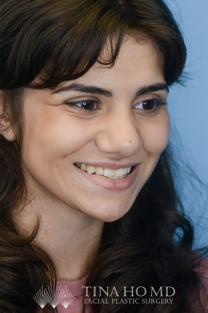 Patient KA's second right oblique view one year after rhinoplasty, alternate view