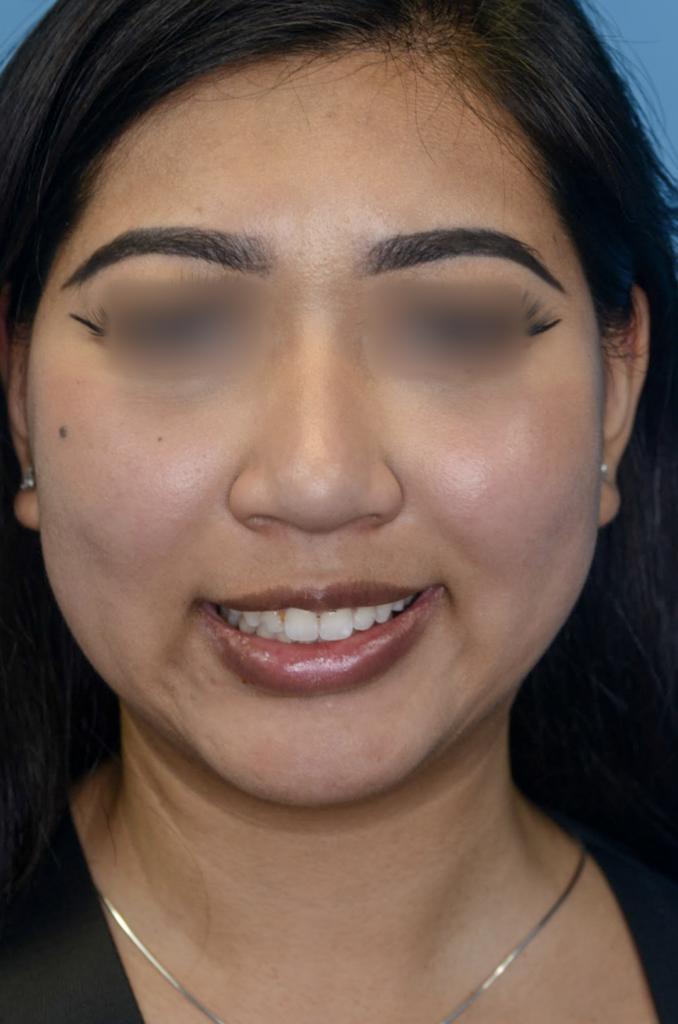 Patient KT's frontal view before jawline contouring procedure
