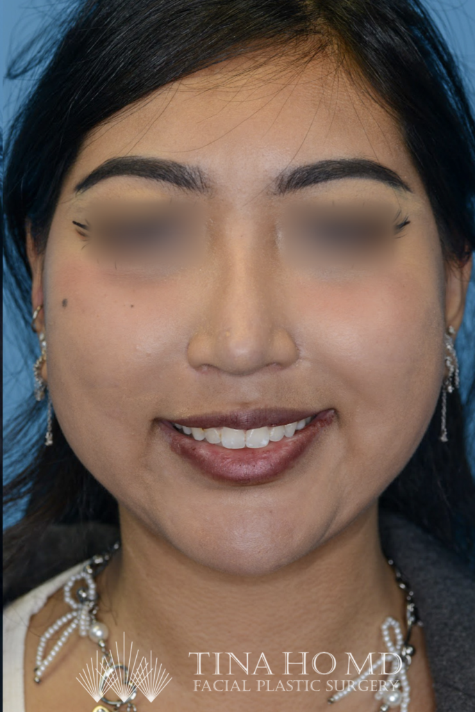 Patient KT's frontal view after jawline contouring procedure
