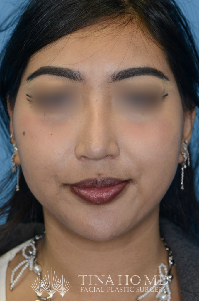 Patient KT's frontal view after jawline contouring procedure