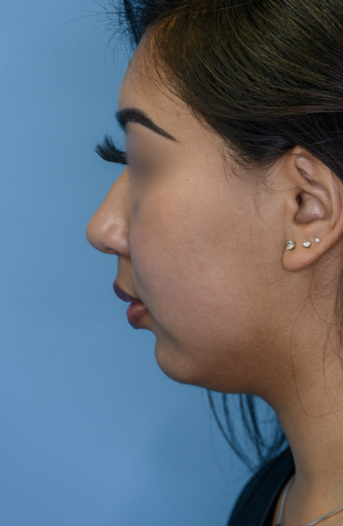 Patient KT's left lateral view before jawline contouring