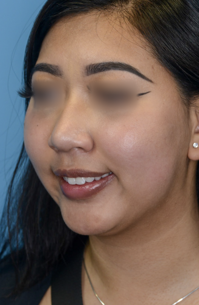 Patient KT's left oblique view before jawline contouring