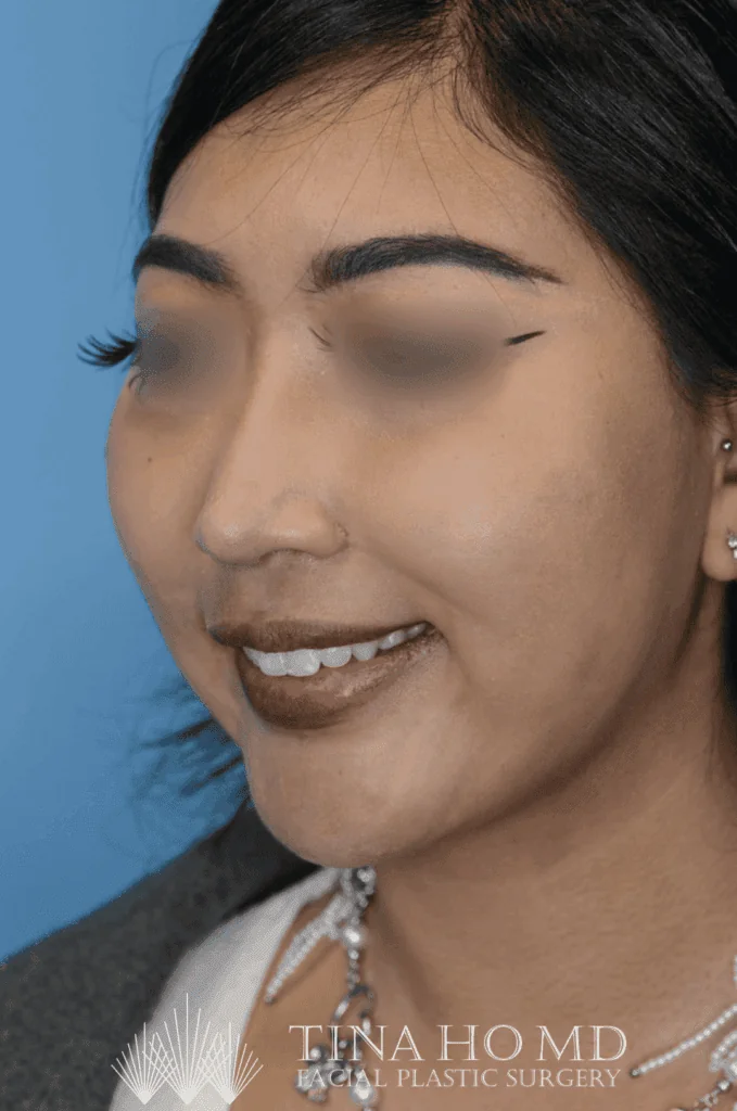 Patient KT's left oblique view after jawline contouring