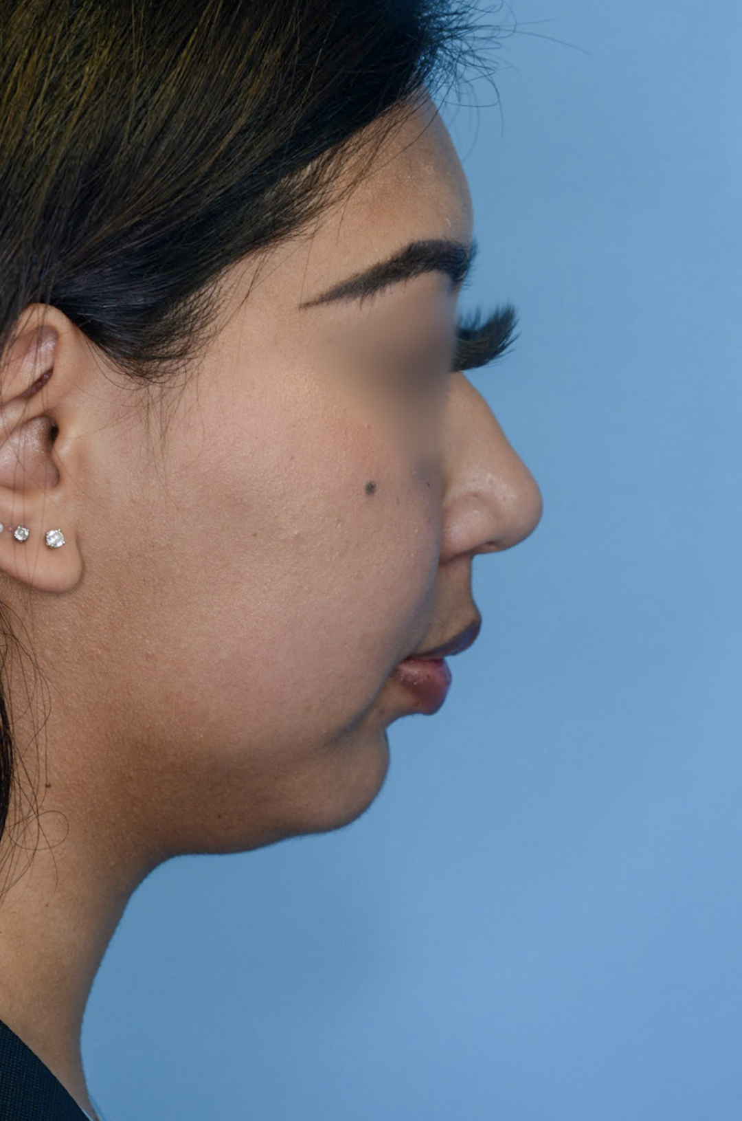 Patient KT's right lateral view before jawline contouring
