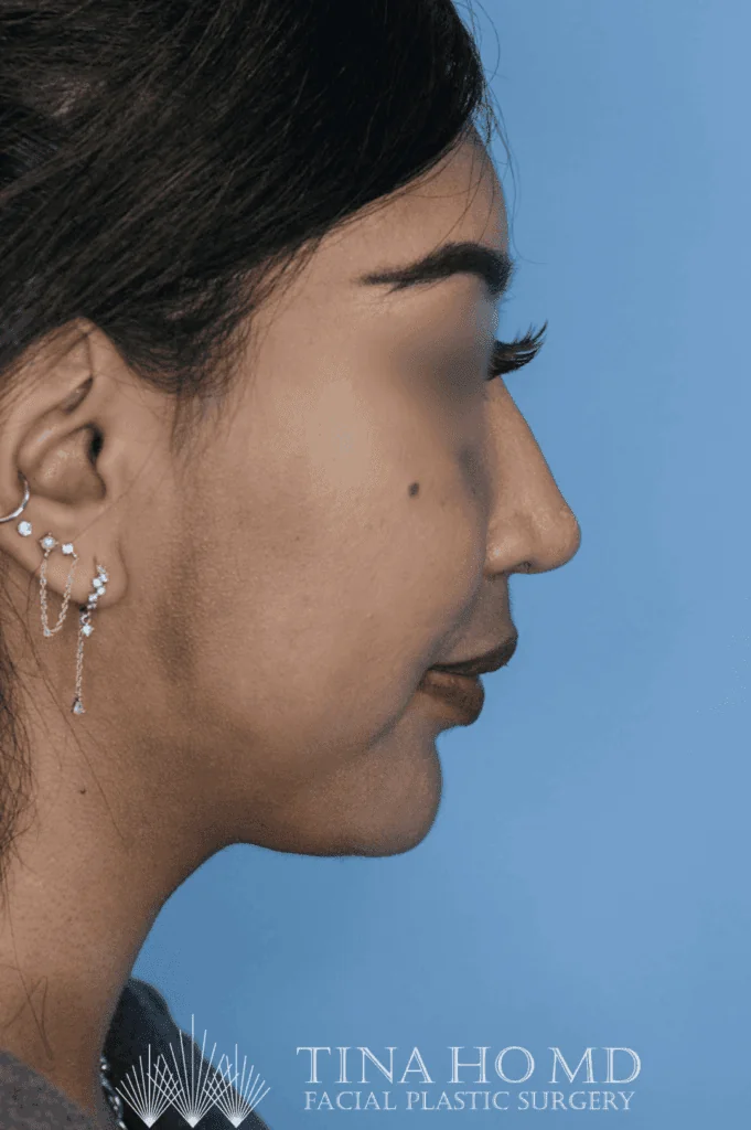 Patient KT's right lateral view after jawline contouring