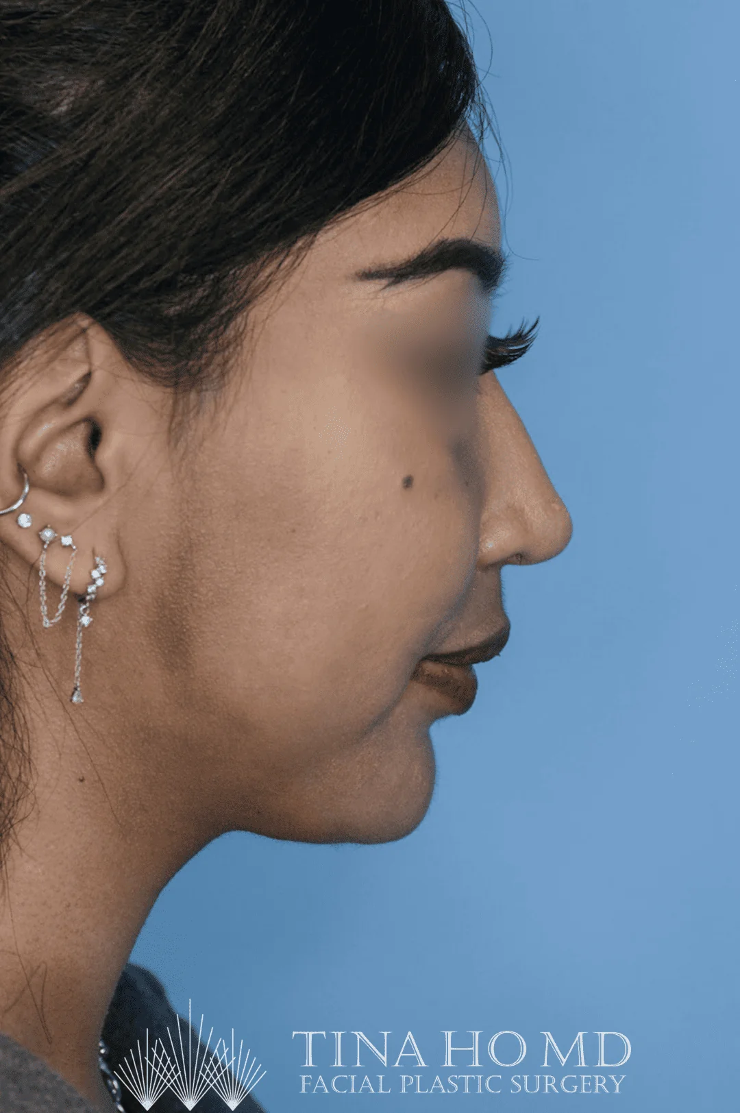 Patient KT's right lateral view after jawline contouring