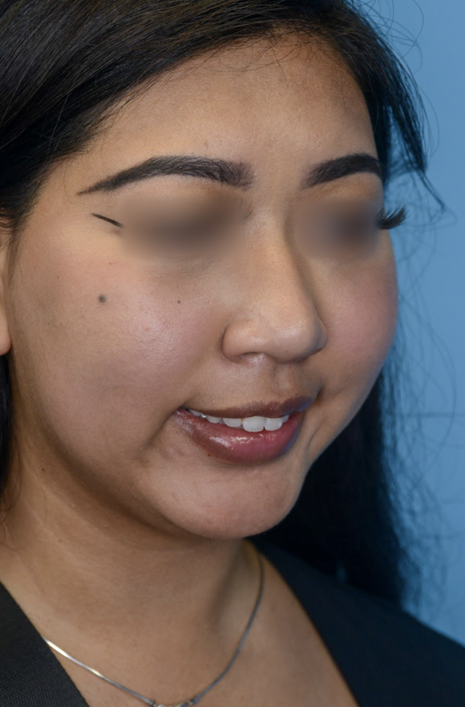 Patient KT's right oblique view before jawline contouring