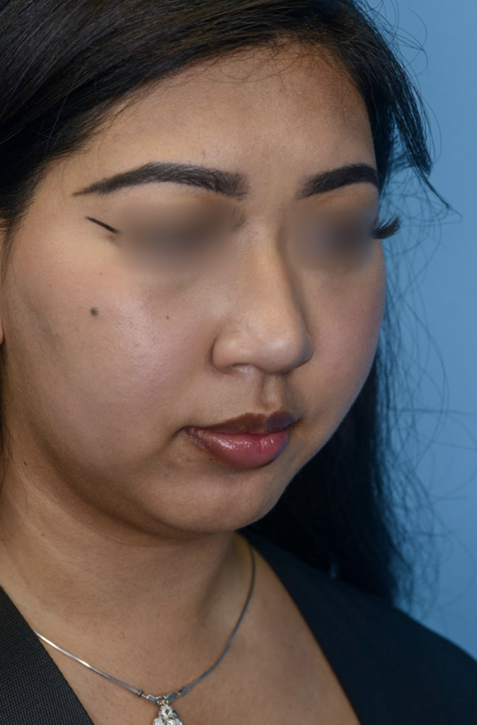 Patient KT's right oblique view before jawline contouring