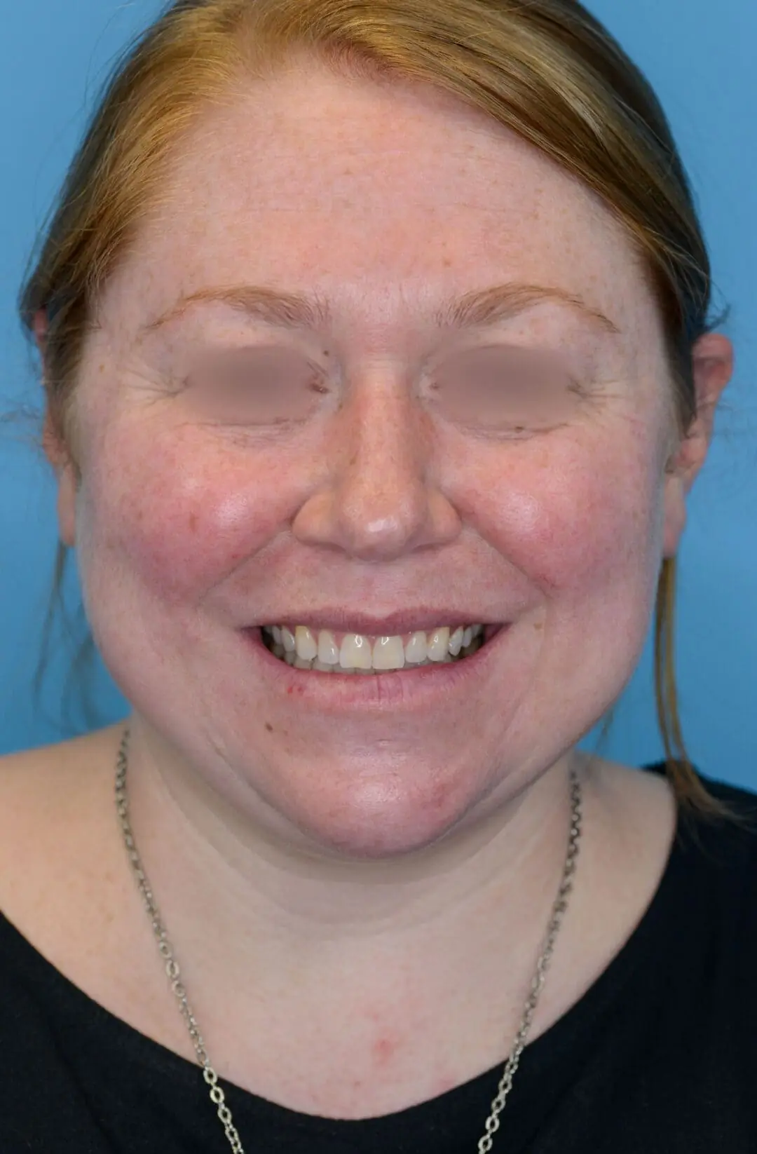 Patient NL's frontal view, before facelift and brow lift surgery