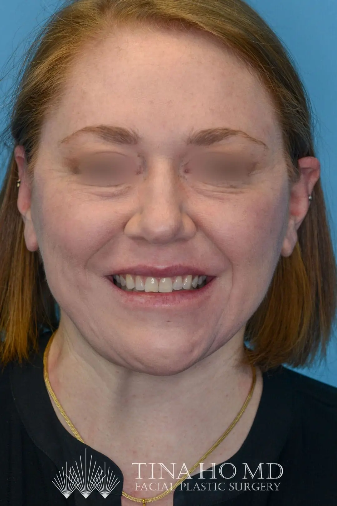 Patient NL's frontal view, showing improved facial contours and brow lift after surgery