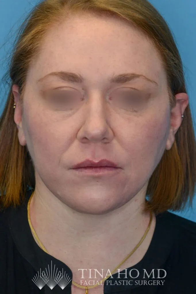 Patient's face, frontal view, after brow lift and facial contours surgery