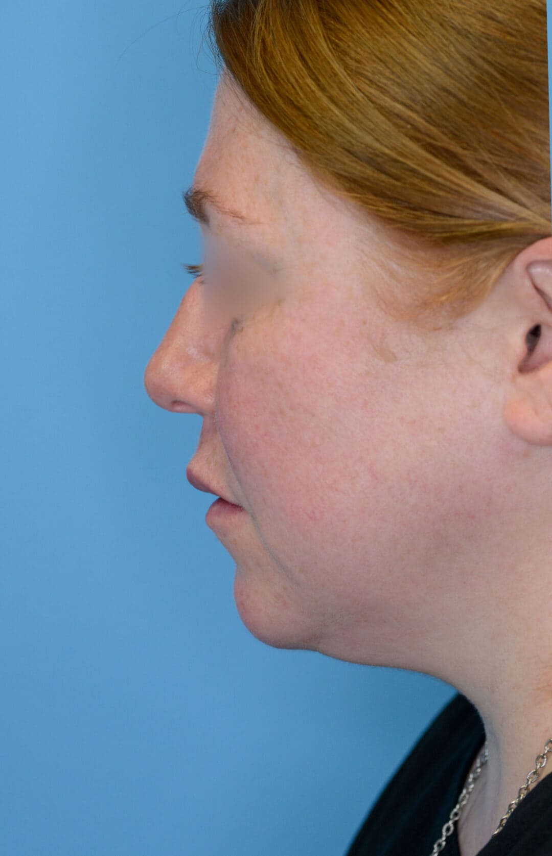 Patient NL's left lateral view, before facelift and brow lift surgery