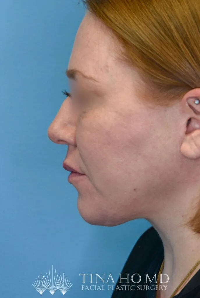 Patient NL's left lateral view, after facelift and brow lift surgery
