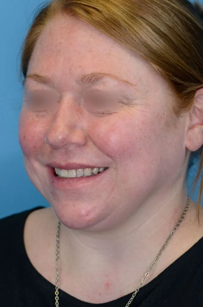 Patient's face, left oblique view, before brow lift and facelift surgery