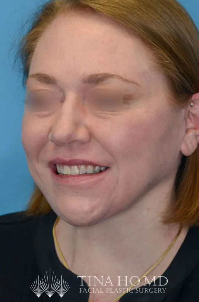 Patient's face, left oblique view, after brow lift and facial contours surgery