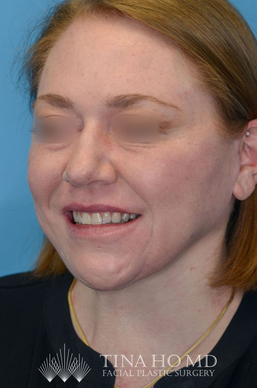 Patient's face, left oblique view, after brow lift and facial contours surgery
