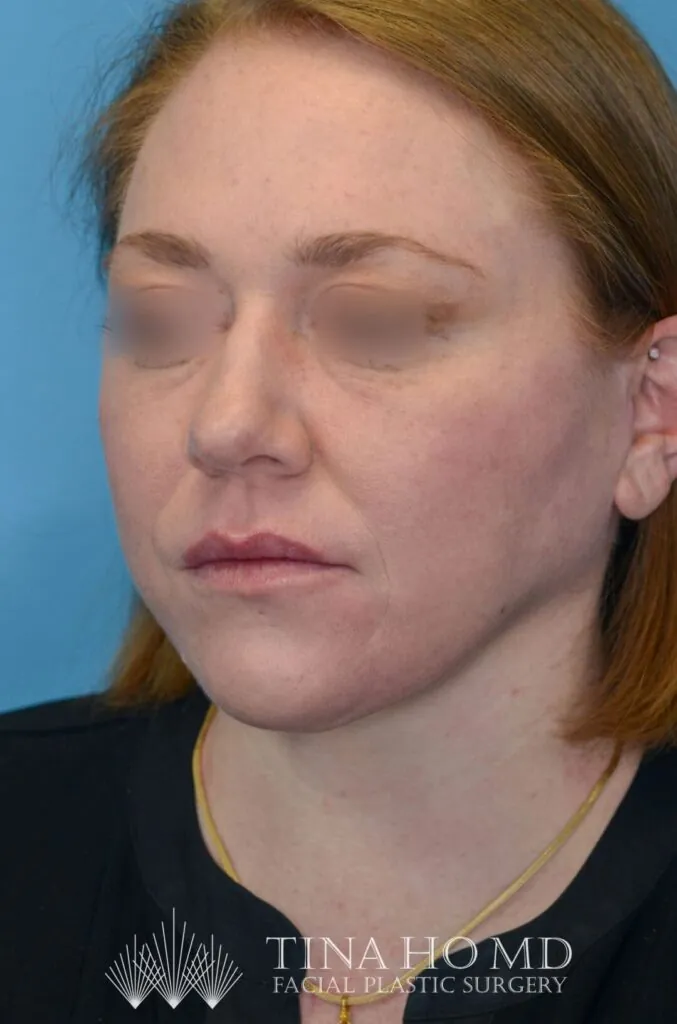 Patient's face, left oblique view, after brow lift and facial contour surgery
