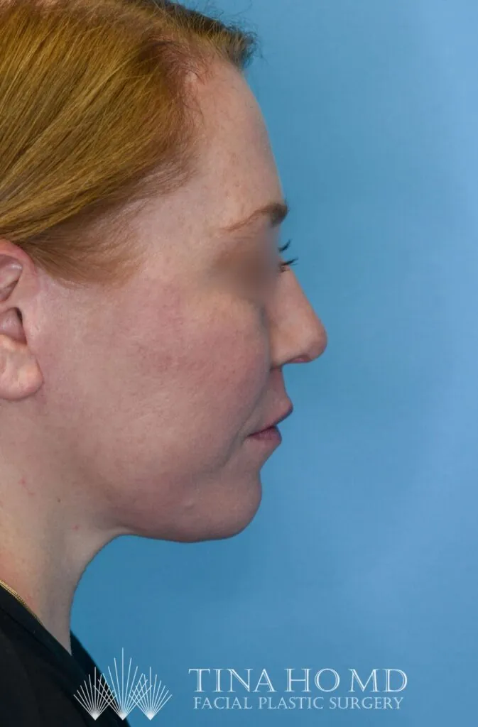 Patient's face, right lateral view, after facelift and brow lift surgery