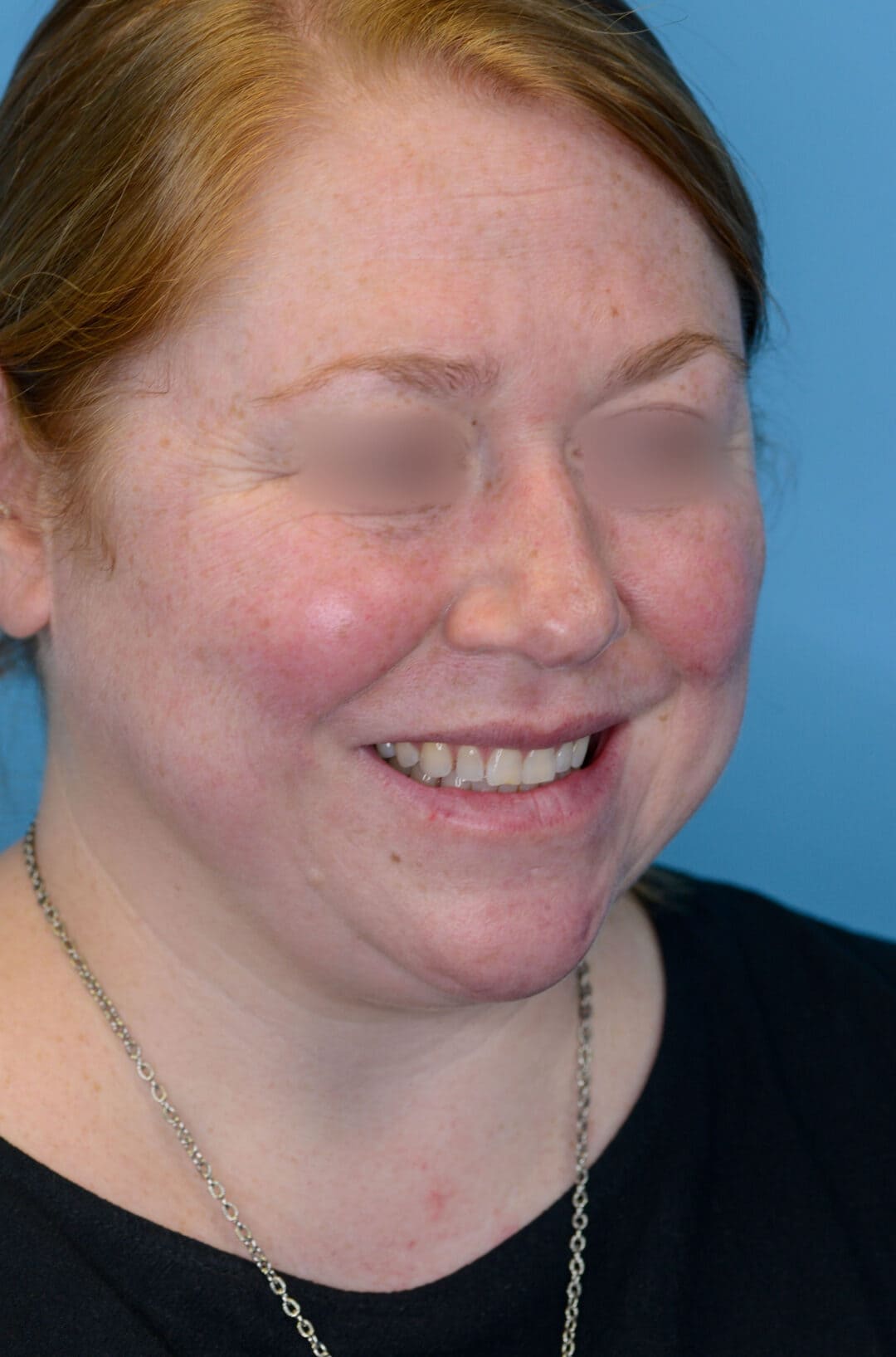 Patient's face, right oblique view, before brow lift and facelift surgery