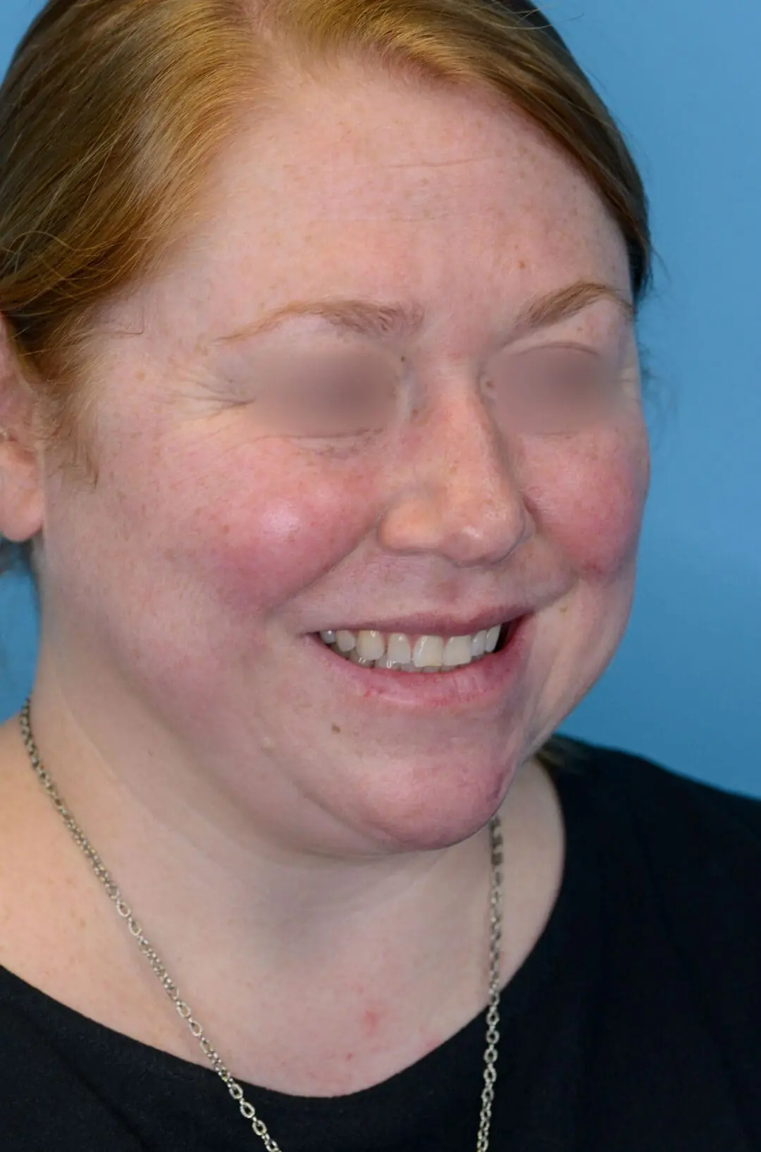 Patient's face, right oblique view, before brow lift and facelift surgery