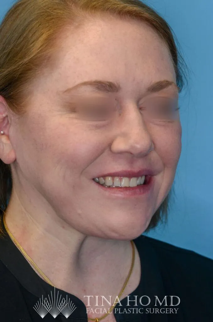 Patient's face, right oblique view, after brow lift and facelift surgery