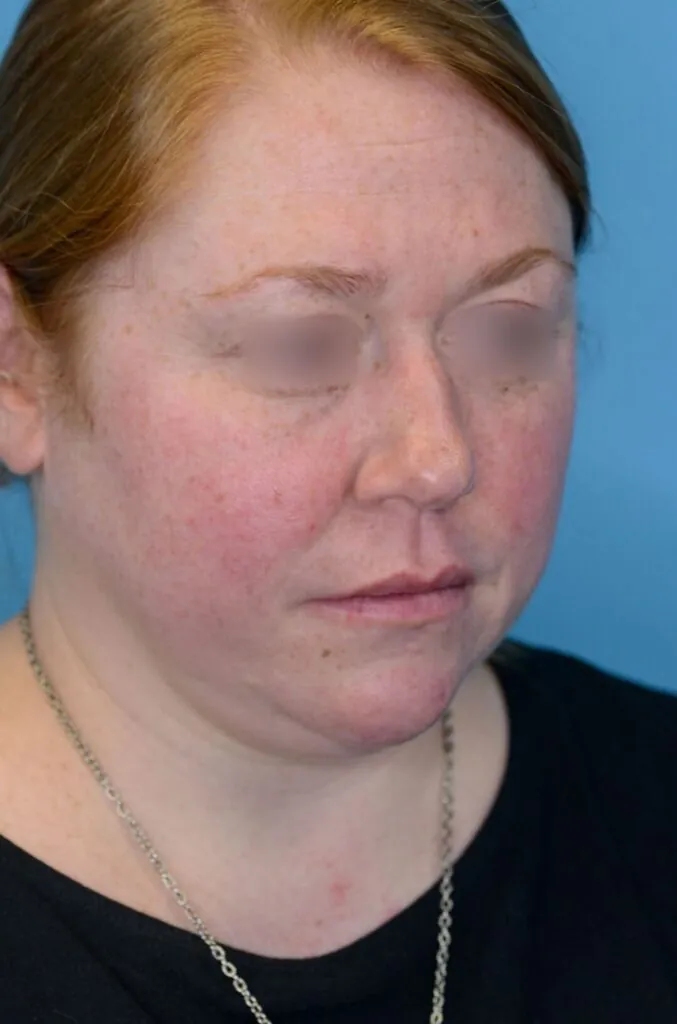 Patient's face, right oblique view, before brow lift and facelift surgery