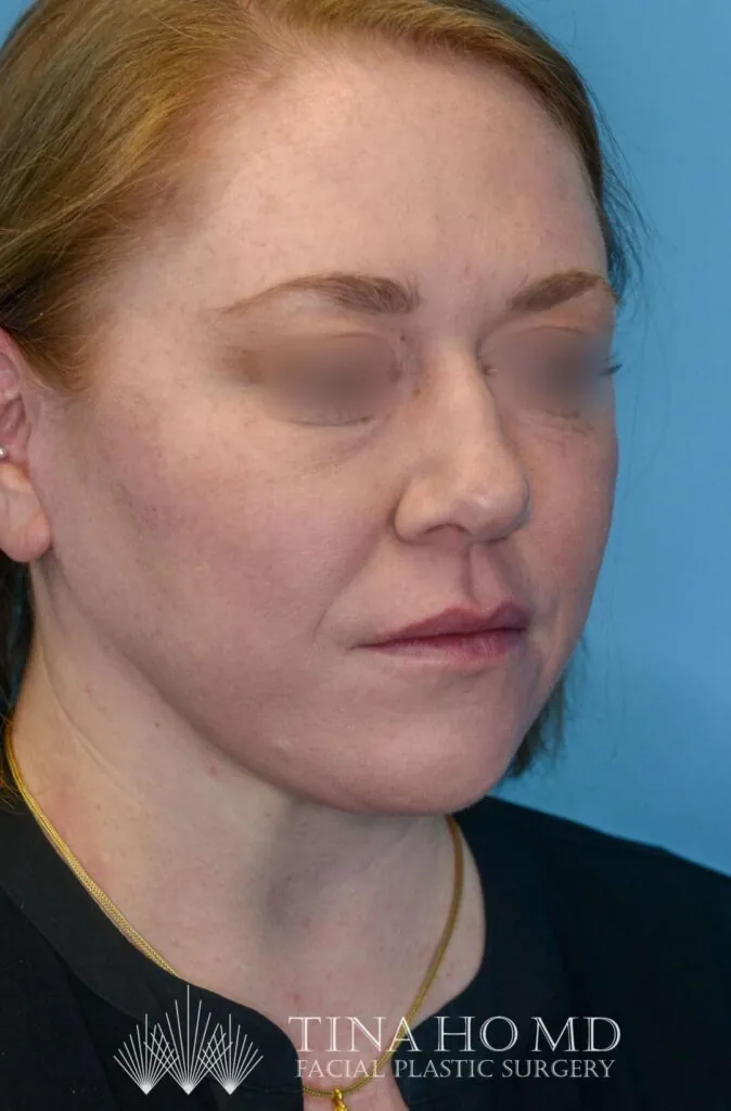 Patient's face, right oblique view, after brow lift and facelift surgery