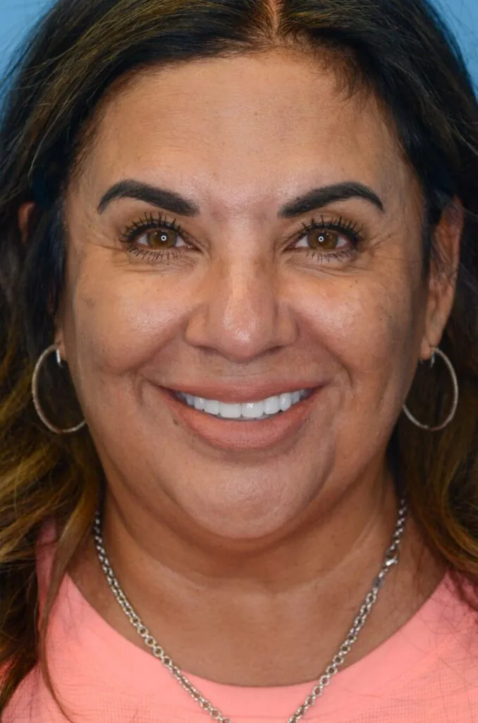 Patient SC's frontal view, before facelift surgery, showing natural facial contours and natural lips before lip filler