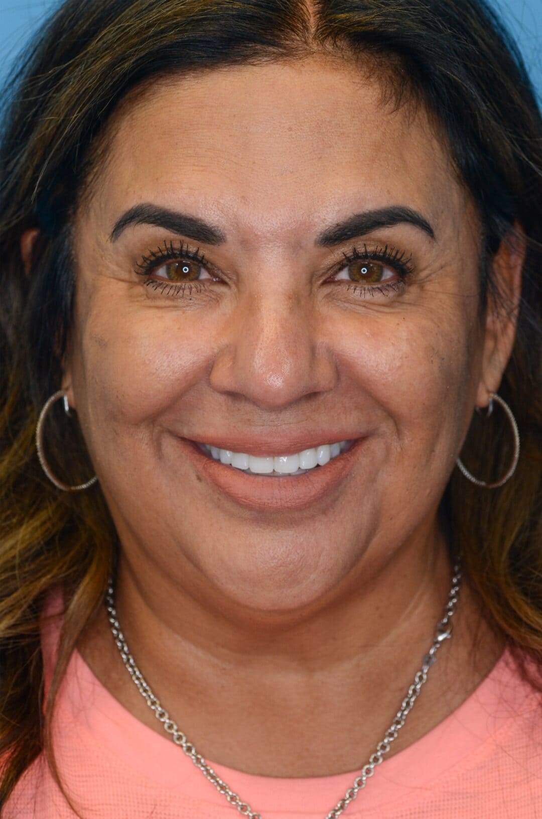 Patient SC's frontal view, before facelift surgery, showing natural facial contours and natural lips before lip filler