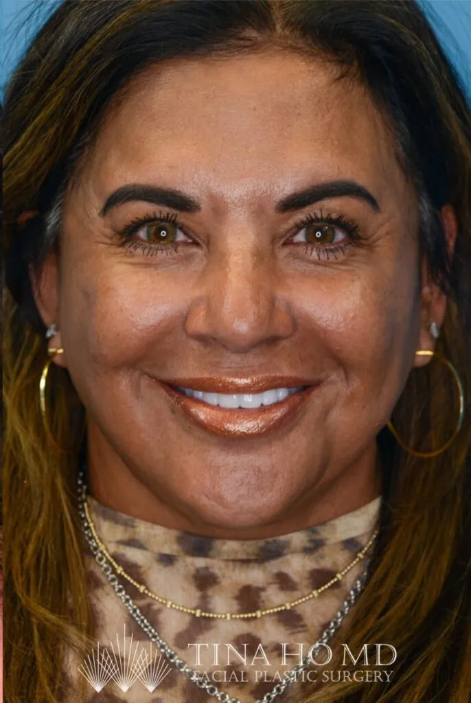 Patient SC's frontal view, with enhanced facial contours and fuller, defined lips after surgery and lip filler