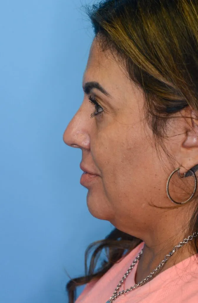 Patient SC's left lateral view, before facelift surgery, showing natural facial contours and natural lips before lip filler