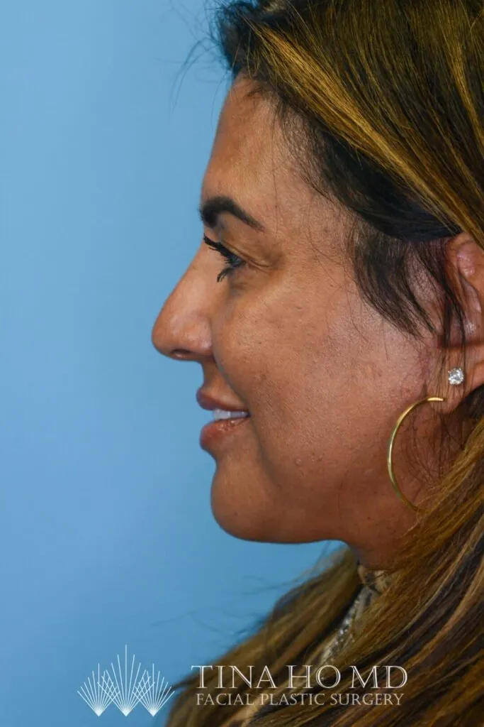 Patient SC's left lateral view, with enhanced facial contours and fuller, defined lips after surgery and lip filler