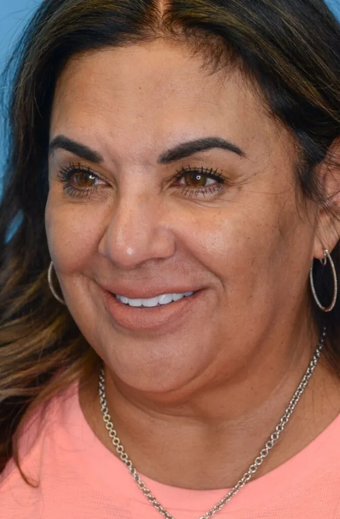 Patient SC's left oblique view, before facelift surgery, showing natural facial contours and natural lips before lip filler