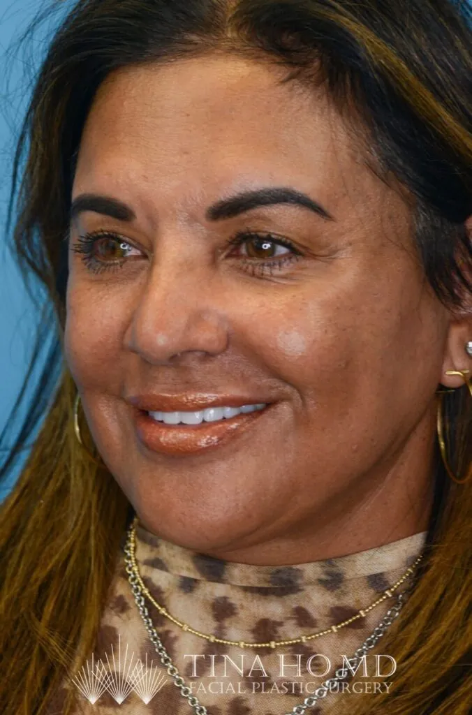 Patient SC's left oblique view, with enhanced facial contours and fuller, defined lips after surgery and lip filler