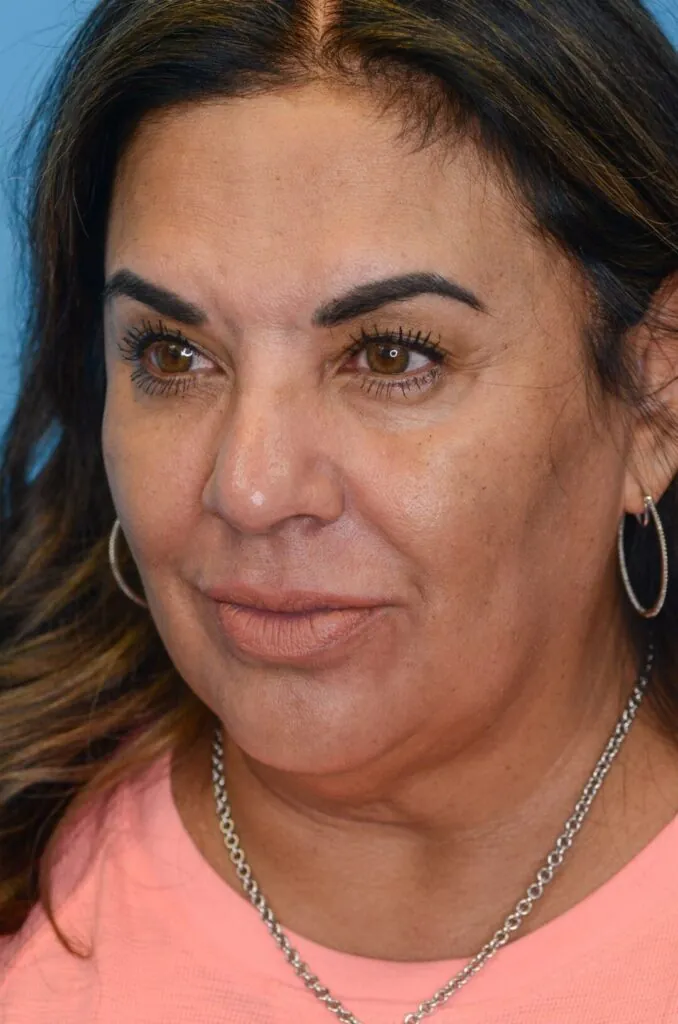 Patient SC's left oblique view, before facelift surgery, showing natural facial contours and natural lips before lip filler