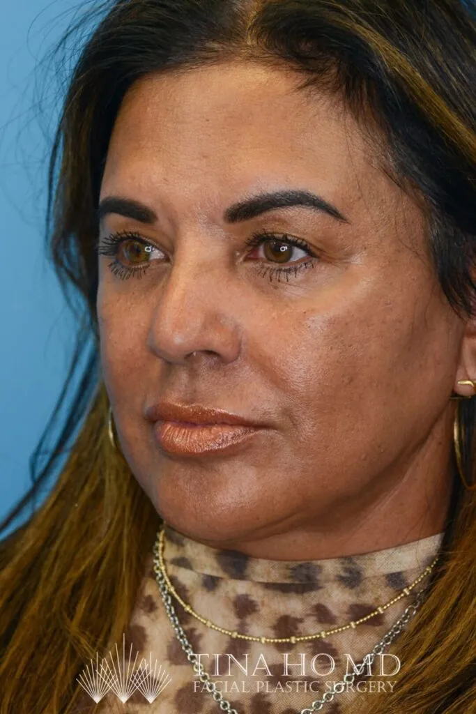 Patient SC's left oblique view, with enhanced facial contours and fuller, defined lips after surgery and lip filler