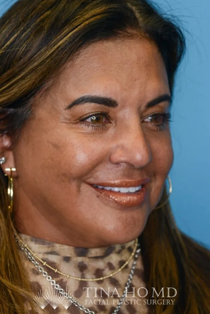 Patient SC, right oblique view with enhanced facial contours and fuller, defined lips after surgery and lip filler