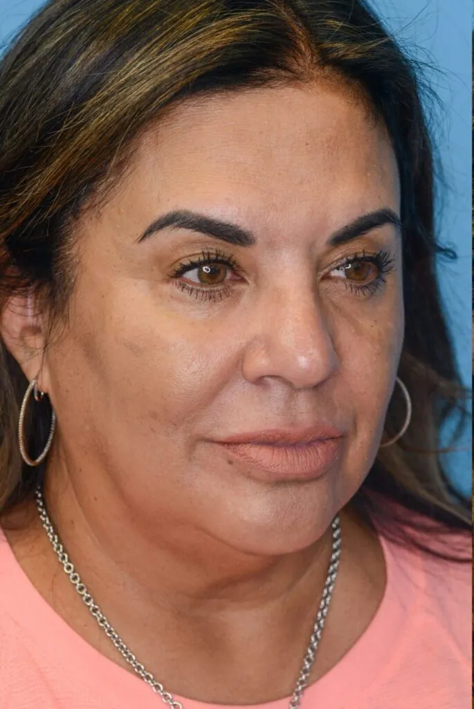 Patient SC, right oblique view before facelift and before lip filler