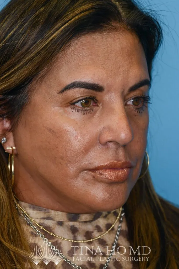 Patient SC, right oblique view with enhanced facial contours and fuller lips after facelift and lip filler.