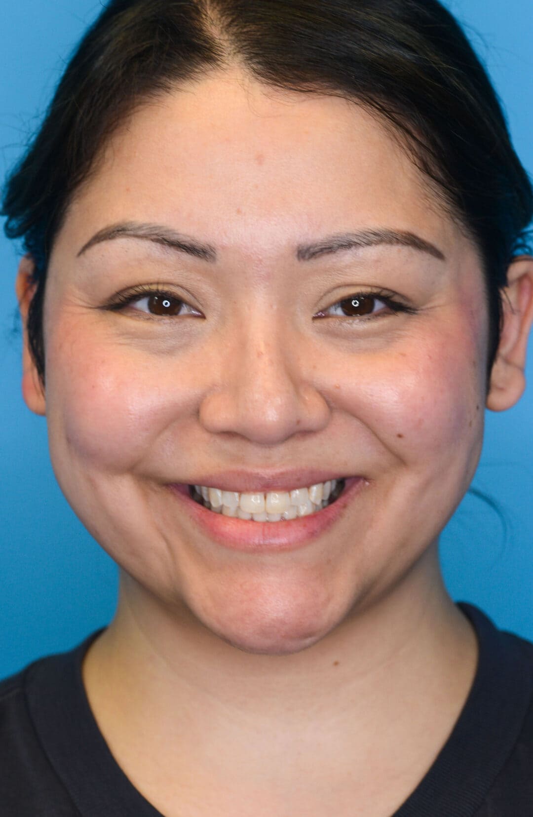 Person's frontal view before neck lift showing loose skin on neck