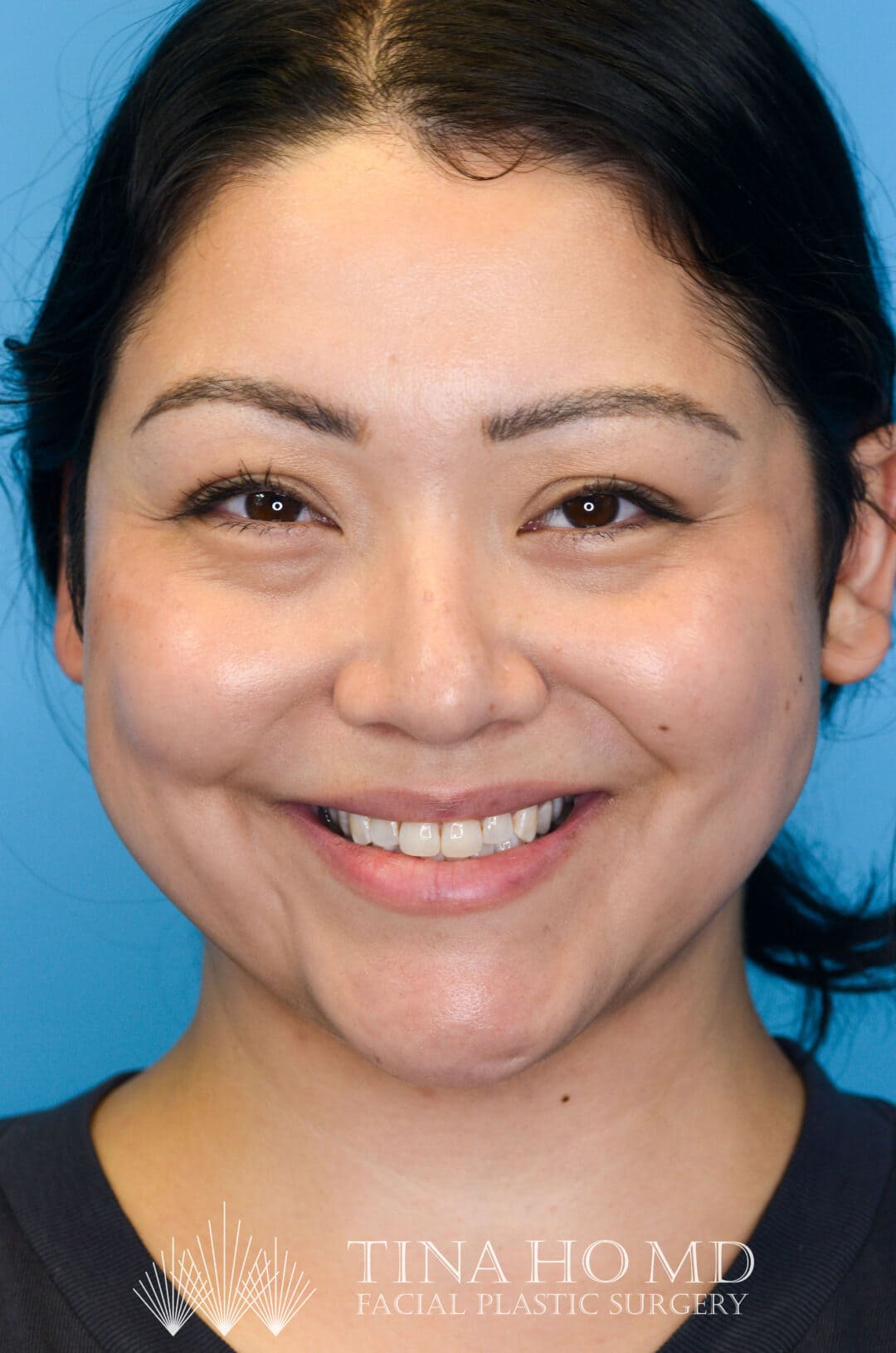 Person's frontal view after neck lift showing a more defined jawline