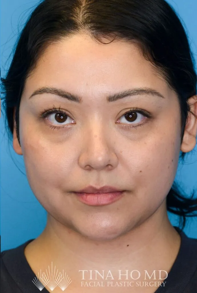 Person's face and neck after a deep plane neck lift results