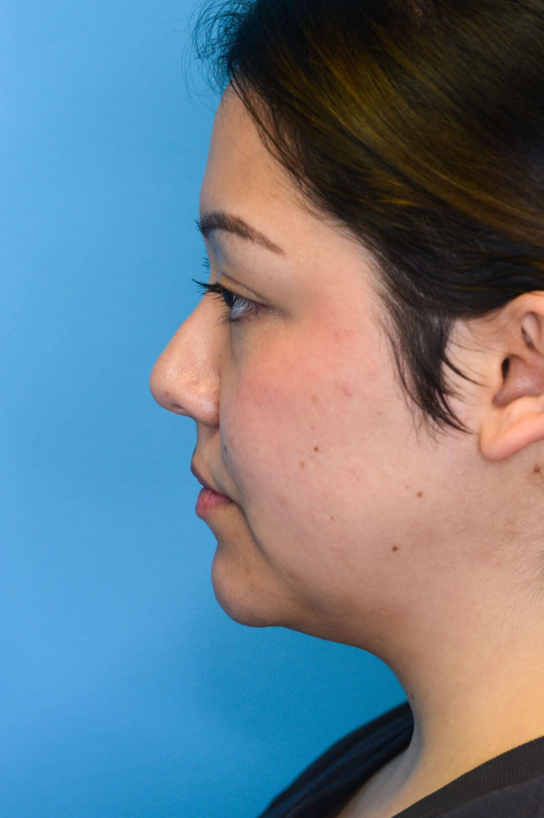 Person's left profile before neck lift showing visible jowls and wrinkles