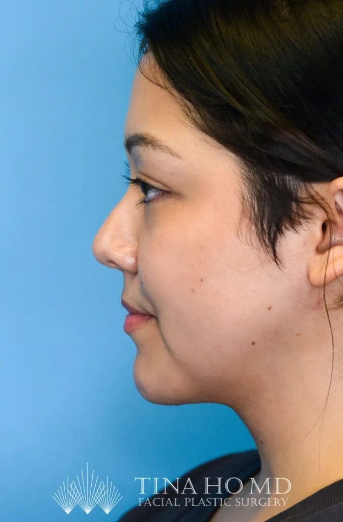 Person's left profile after neck lift with improved jawline and neck
