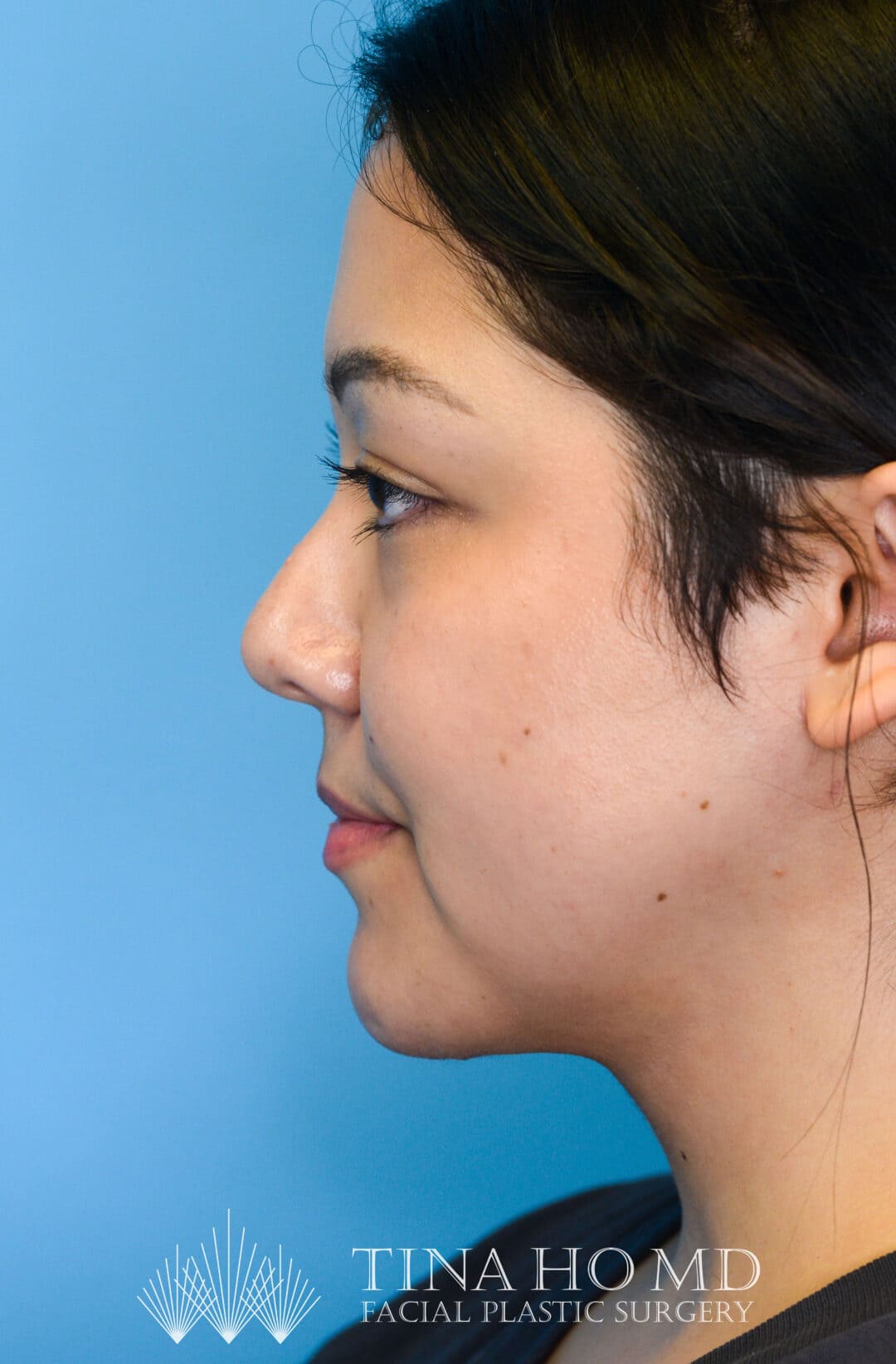 Person's left profile after neck lift with improved jawline and neck