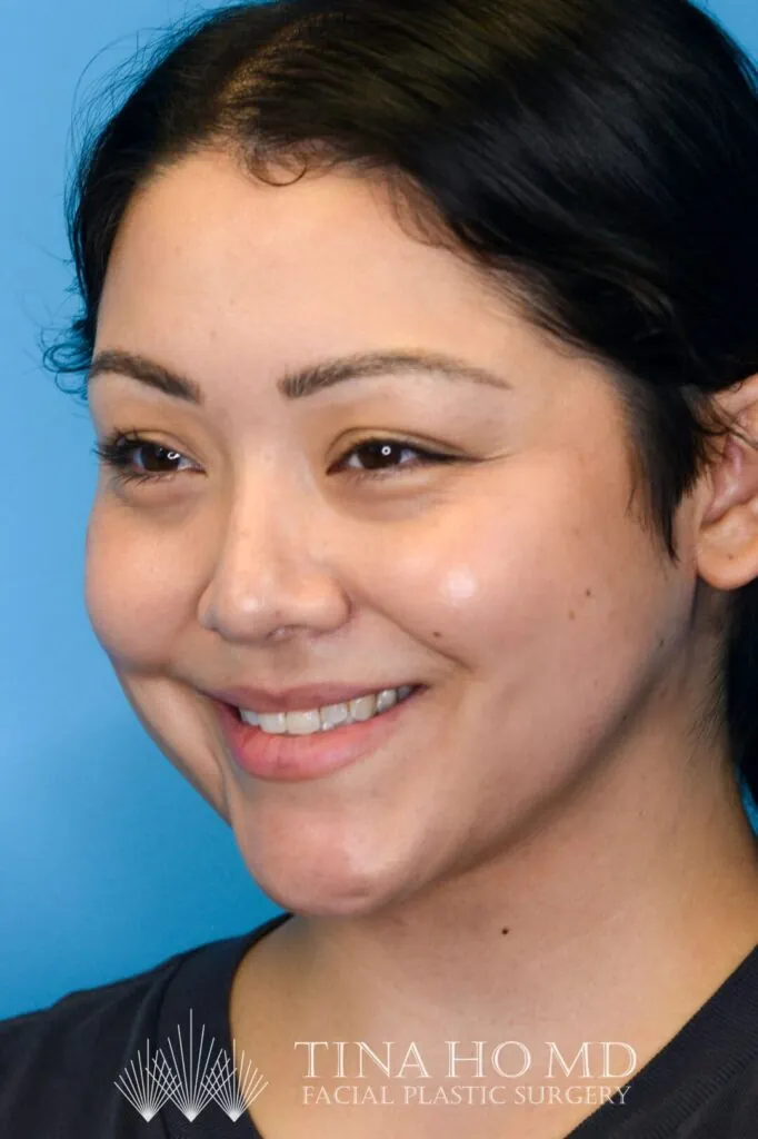 Person's left oblique view after neck lift showing a tighter neckline