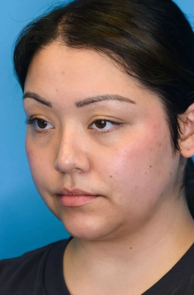 Person's left oblique before neck lift showing loose skin under chin